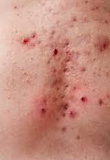 breast on bumps pimples